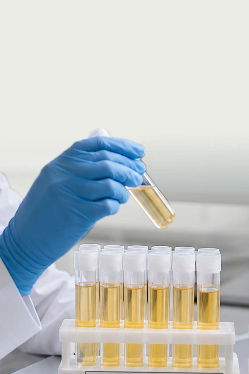 Urinary glycosaminoglycan (uGAG) levels in the clinical study
